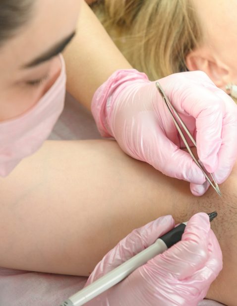 Removal of hair permanently in a woman's armpits using electrolysis.
